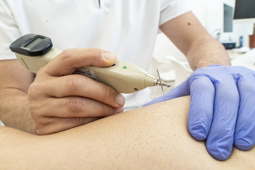 Punció Seca - Kine3 Fisioterapia i osteopatia Terrassa